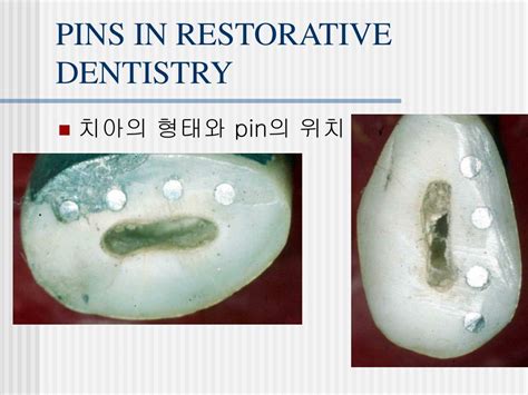 Ppt Use Of Dental Pin Powerpoint Presentation Free Download Id901756