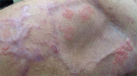 Asteatotic Eczema In Hypoesthetic Skin A Case Series Dermatology