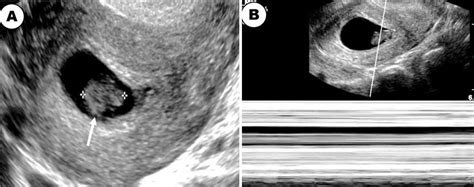 A Transvaginal Ultrasound Showing An Intrauterine Pregnancy With An