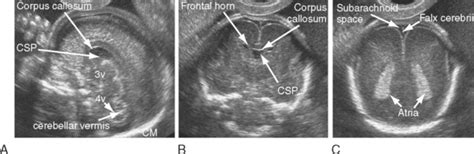 Ultrasound Evaluation Of The Fetal Neural Axis Radiology Key