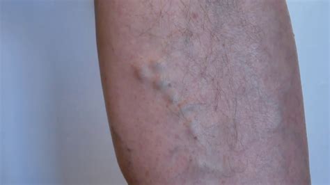 Bulging Or Popping Veins Causes And Treatments