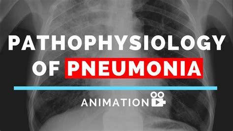 Pathophysiology Of Pneumonia Animation Made Easy Youtube