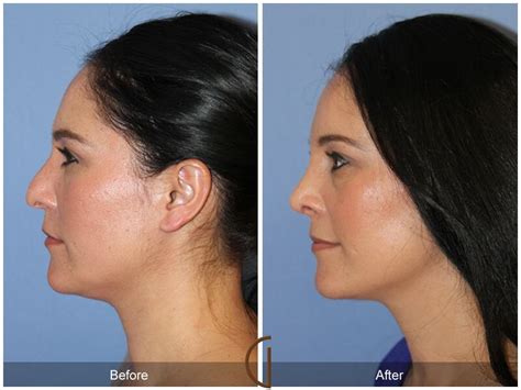Female Rhinoplasty Before And After Photos From Dr Kevin Sadati