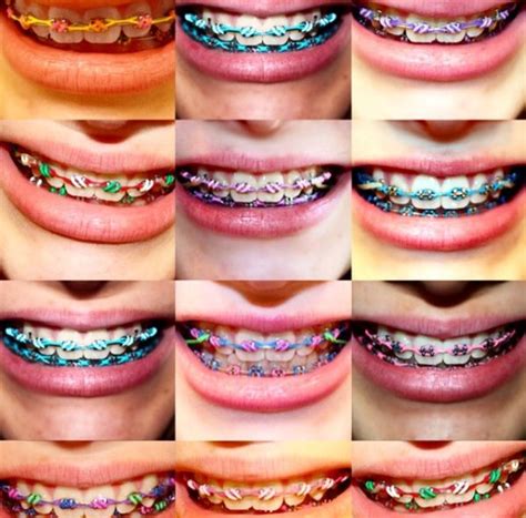 Here in this article you will find all the tips you should know. If you are undecided as to what color braces to get then ...