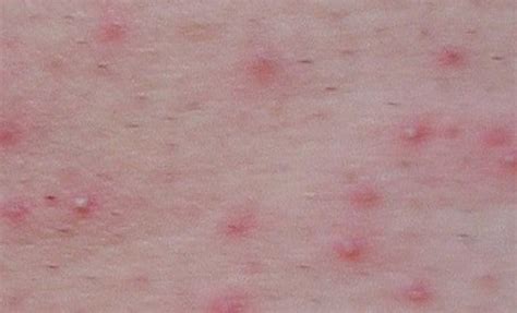 Stress Rash Causes Symptoms Pictures And Treatment