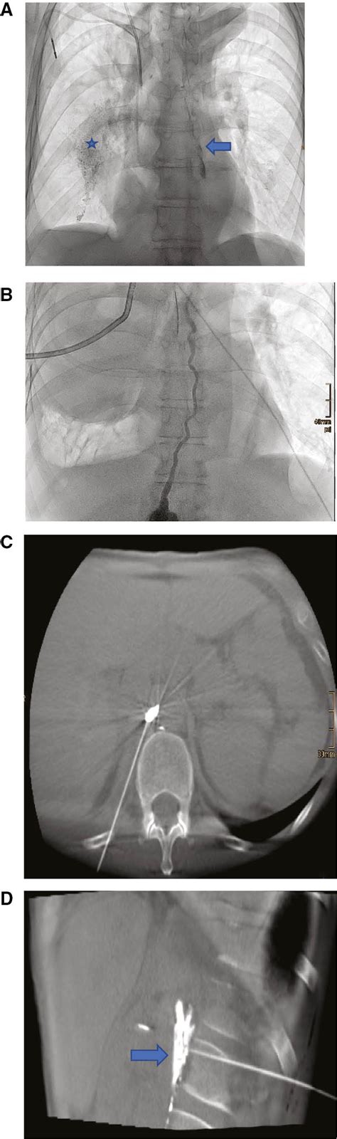 Ultrasound Guided Lymphangiography And Interventional Embolization Of