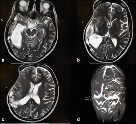Ac T2 Weighted Mri Illustrates Post Ischemia Changes Of The Right