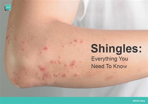 shingles causes symptoms risk factors treatment halza