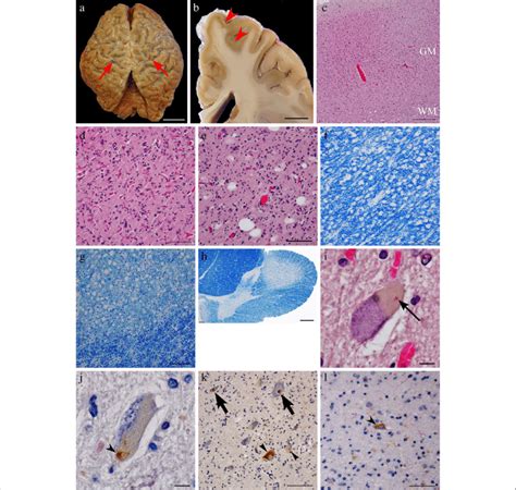 Autopsy Findings Of Amyotrophic Lateral Sclerosis Als Pathology Top