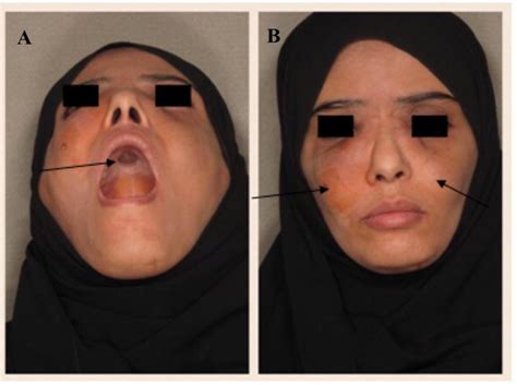 A Central Hard Palate Lesion B Swelling Over Both Sides Of The