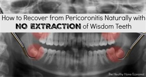 Wisdom Tooth Pericoronitis How To Avoid Extraction Healthy Home