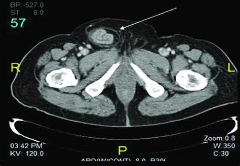 A Ct Scan With Contrast Showing An Irreducible Hernia Arrow