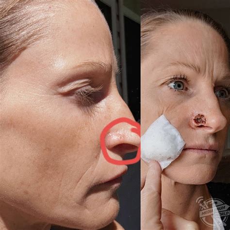 This Mums Spot Turned Out To Be Skin Cancer And Left Her With A Gaping Hole On Her Nose Media