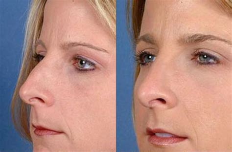 Nose Reshaping Before And After Photos Patient 100 Louisville Ky