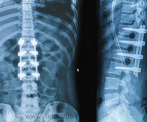 Spinal Fusion Types Risks Complications And Prognosis