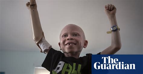 Tanzania Children With Albinism Receive New Limbs After Vicious