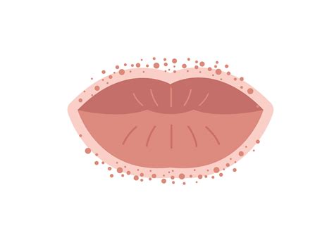 Thrush White Spots On Lips