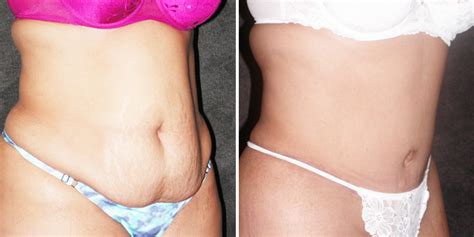 Before And After Abdominoplasty Gallery Los Angeles Ca Kao