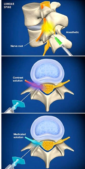 Lumbar Transforaminal Epidural Steroid Injection The Southeastern