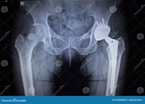 X Ray Scan Image Of Hip Joint Replacement Orthopedic Implant Stock