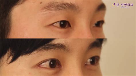 Double Eyelid Surgery In Korea Before And After View Plastic Surgery