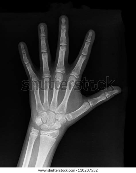 Human Left Hand Xray Medical Image Stock Photo Edit Now