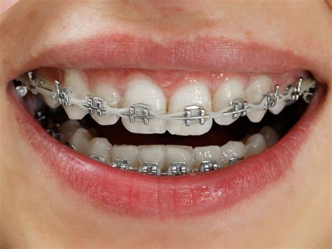 If you brace yourself for something unpleasant or difficult , you prepare yourself for. New Technology Braces