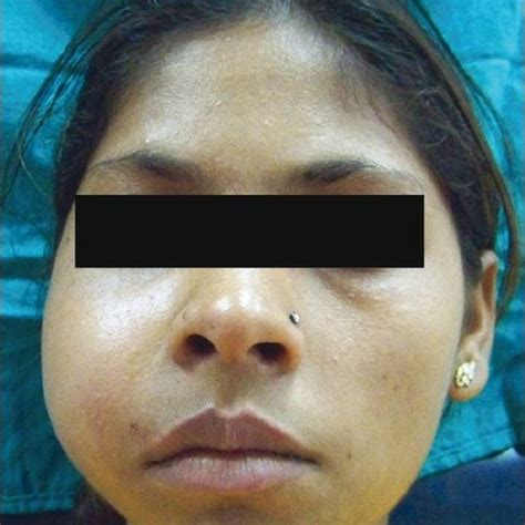 Facial Asymmetry Due To A Diffuse Swelling On The Right Side Of The