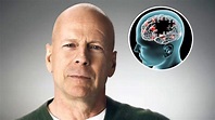 Bruce Willis tiene demencia frontotemporal, ¿qué es y cuáles son los ...