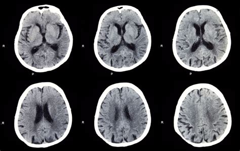 10 Common Brain Diseases Facty Health