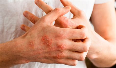 Confirmar Halc N Charles Keasing Dermatitis Atopica Mu Ecas S Ntomas Productivo Limpiador
