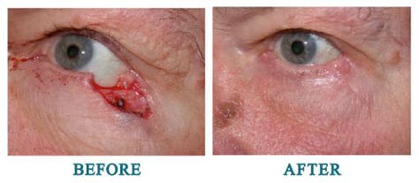 Beforeafter Ophthalmic Plastic Surgery Photos Dr Malone