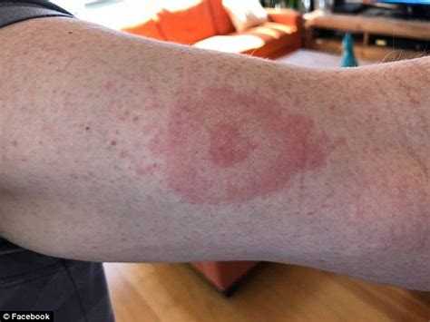Lyme Disease Hotspot Is Declared After Mans Tick Bite Blows Up Into