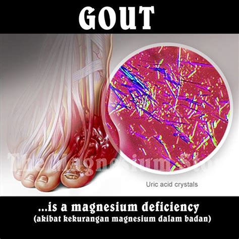 Untuk mengetahui cukup atau tidaknya air dalam tubuh bisa dilihat dari warna urine. Kurang #magnesium dalam badan #gout menyerang... Ramai ...