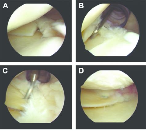 Steps Taken During Arthroscopic Repair Of The Posterior Medial Meniscus Download Scientific