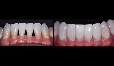 How Bioclear Empowers Dentists To Treat Black Triangles Optident