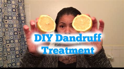 How To Get Rid Of Dandruff And Scalp Eczema Using Lemons Youtube