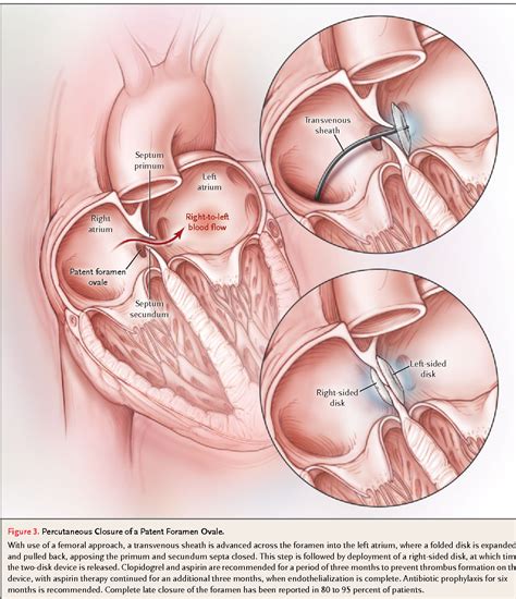 Figure 3 From Clinical Practice Patent Foramen Ovale In