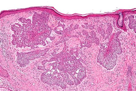 Nevoid Basal Cell Carcinoma Syndrome Libre Pathology