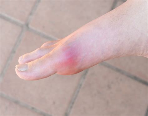 What Causes Severe Pain In The Ball Of The Foot My Footdr
