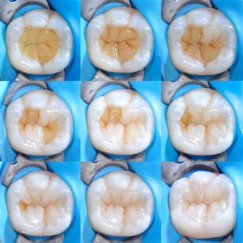 How To Recreate The Occlusal Anatomy Of A Molar With All The Fissures