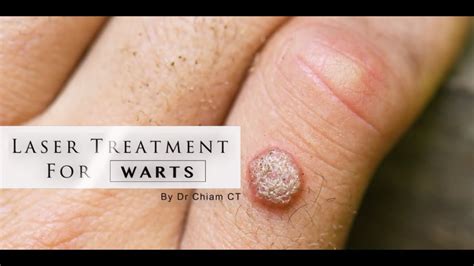Warts Removal With Laser Treatment Dr Chiam Ct Youtube