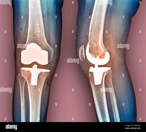 X Ray Of Knee Replacement Hi Res Stock Photography And Images Alamy