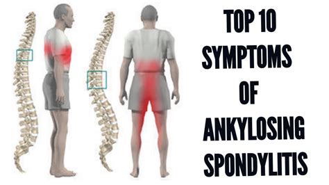 Top 10 Symptoms Of Ankylosing Spondylitis Latest Youtube