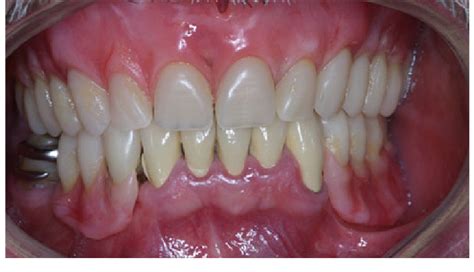 I understand that removable prosthetic appliances (partial dentures) and full there is a charge for relining dentures. Removable partial denture and complete maxillary denture ...