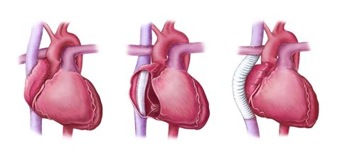 Emma Scheltema Illustration Fontan Procedure Published In Emj Cardiology