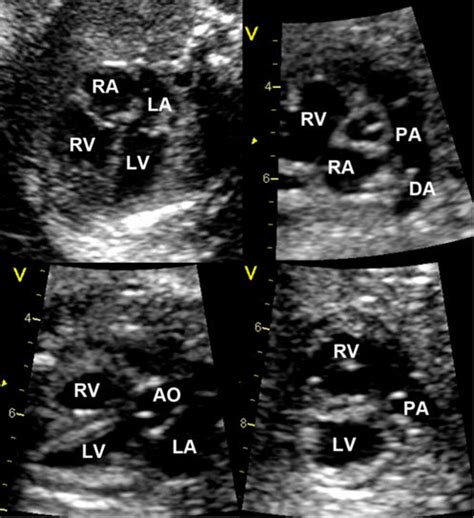 Fetal Echocardiogram During The Second Trimester Can Clearly Show Download Scientific Diagram