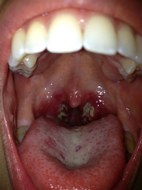 In very rare cases they can potentially grow to be as large as a golf ball or bigger if they grow for long periods of time. Tonsil Stones : popping