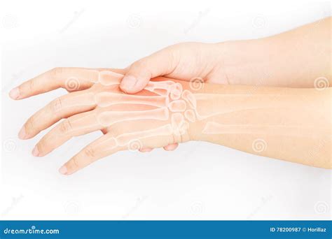 Hand Bone Pain Stock Image Image Of Joints Fracture 78200987