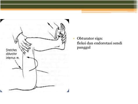 Gejala paling penting, sering dan penting dari apendisitis akut. Acute Appendicitis
